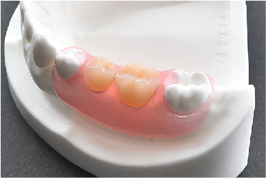 ノンクラスプデンチャー