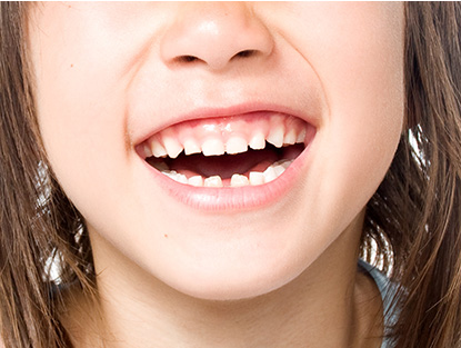 イメージ画像 フッ素塗布