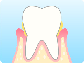 龍ケ崎市歯医者サンロード歯科・中度歯周炎